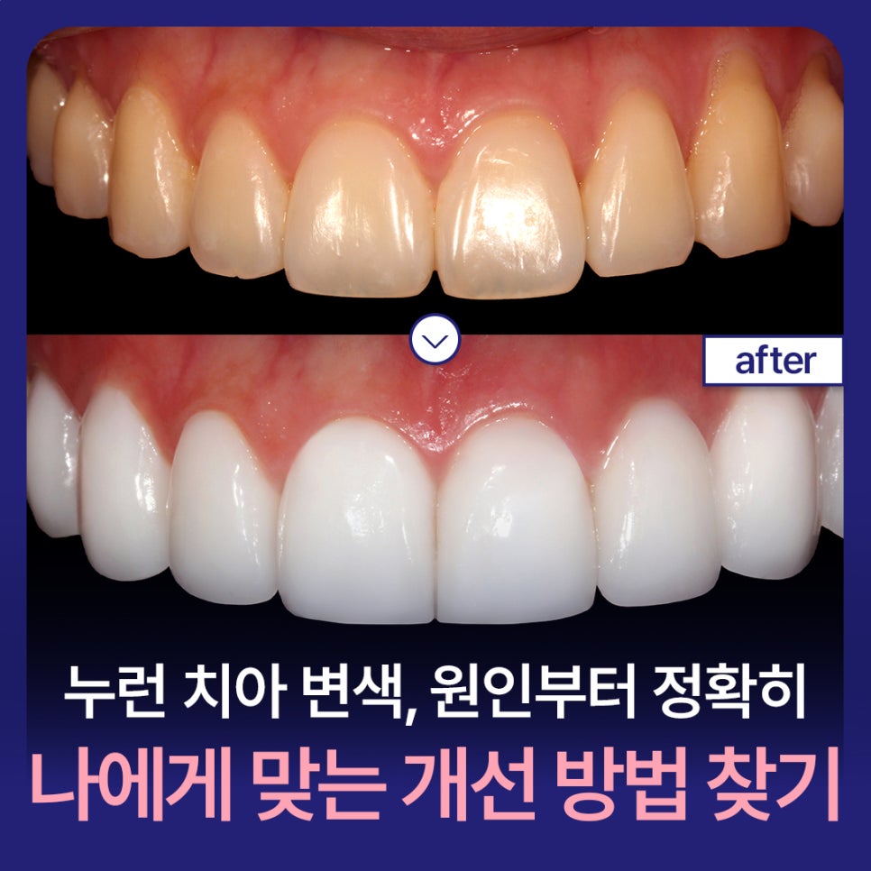 Yellowed Teeth and Discoloration: From the Cause to the Right Improvement Method for Me image 1