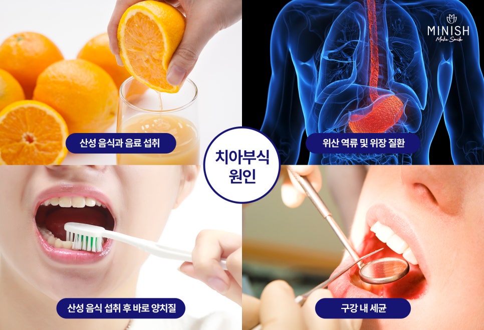 Tooth Erosion: If Left Untreated, It’s Hard to Recover! A Complete Guide to Treatment by Stage image 2