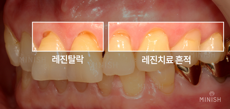 [Tooth Aging] Do Teeth Age, Too? Restoring Them Healthily with Minishe image 7