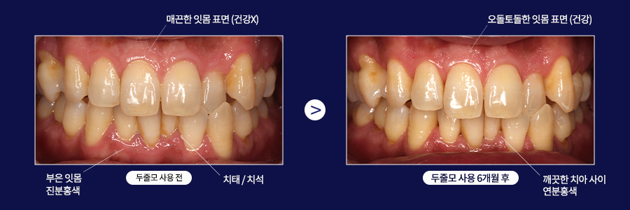 치과, 아직도 치료하러 가세요? | 구강보건의날 특집 관련 이미지 8