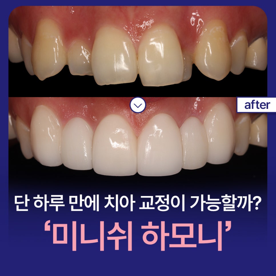 Is It Possible to Straighten Teeth in Just One Day? image 1