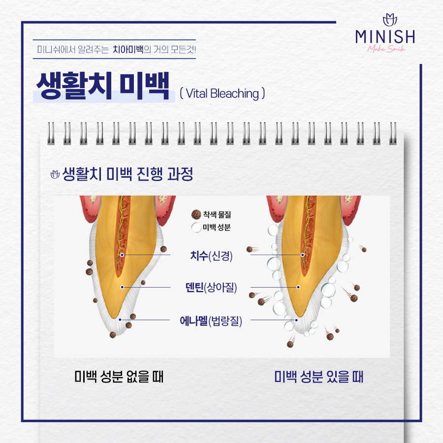 치아미백의 거의 모든 것 관련 이미지 3