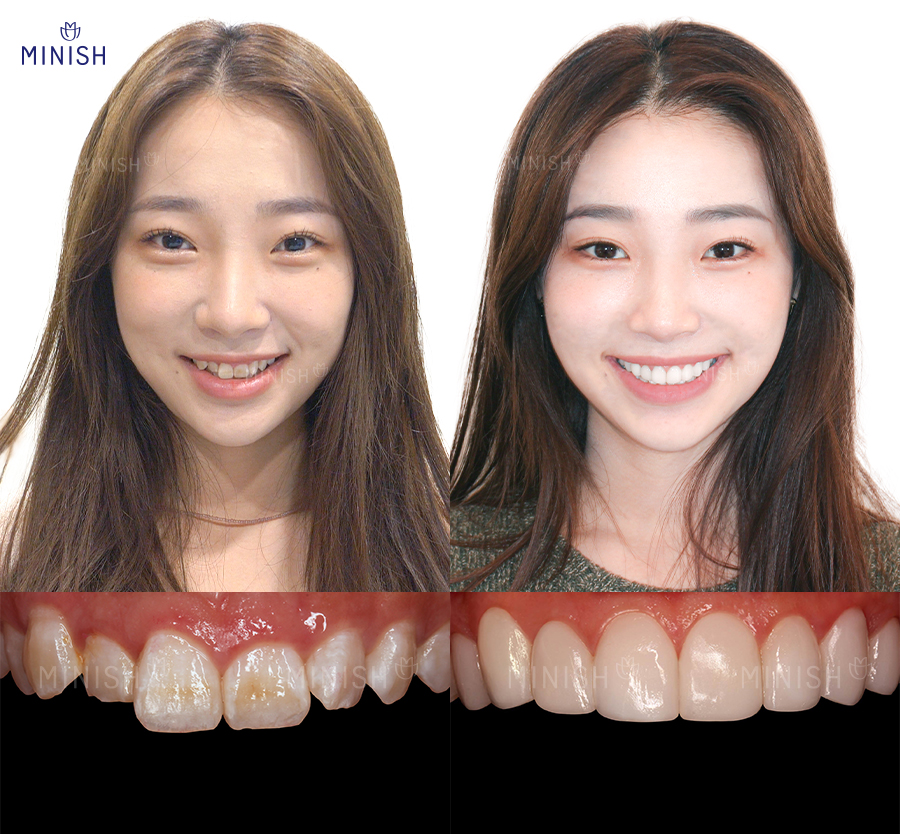 치아 콤플렉스? 치아성형 대신 미니쉬 관련 이미지 5