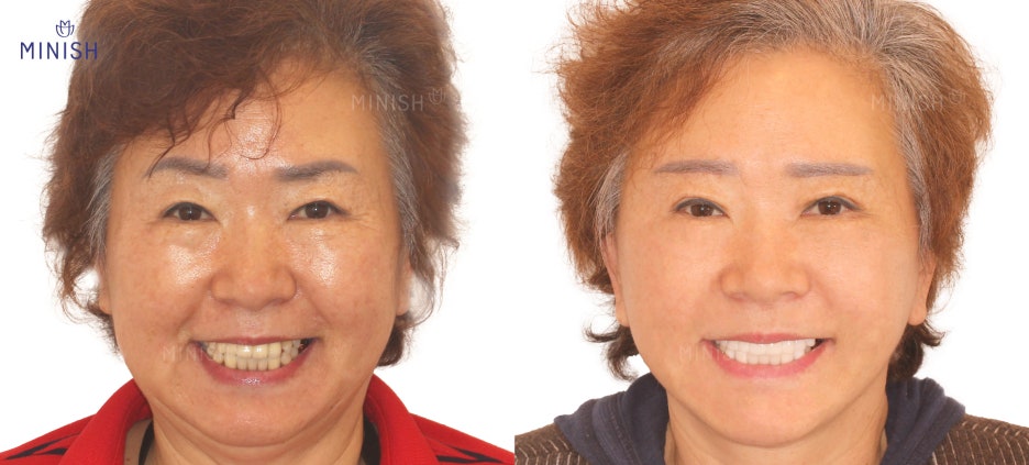 잘못된 크라운! 재치료하다 | 강남구청치과 관련 이미지 2