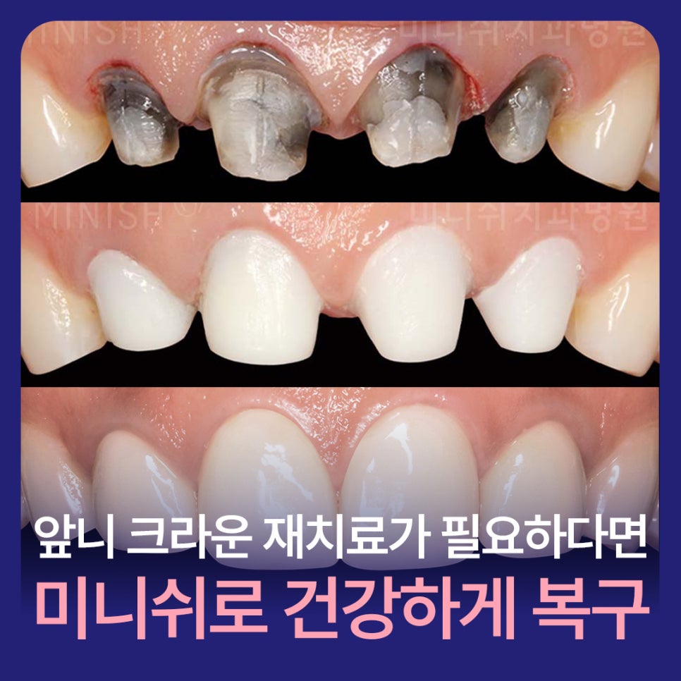 앞니 크라운 재치료가 필요하다면? 미니쉬로 건강하게 복구하세요 관련 이미지 1