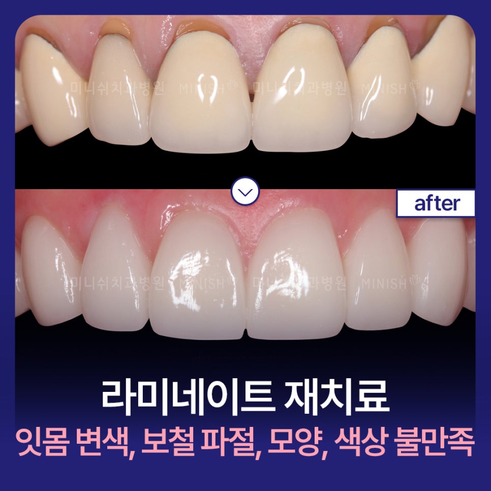 Laminates Retreatment: Be Sure to Know This Before You Proceed! image 1