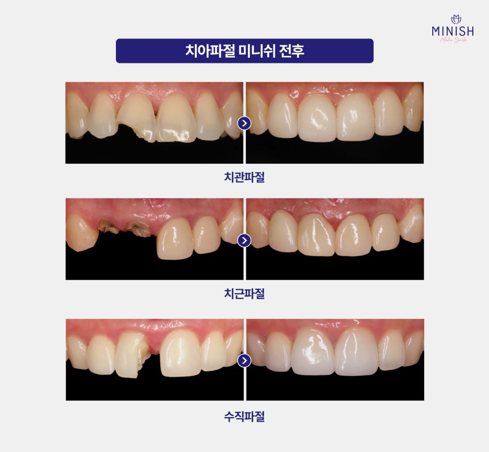 Sudden Tooth Breakage: Where Should You Go If You’re Not Sure? image 5