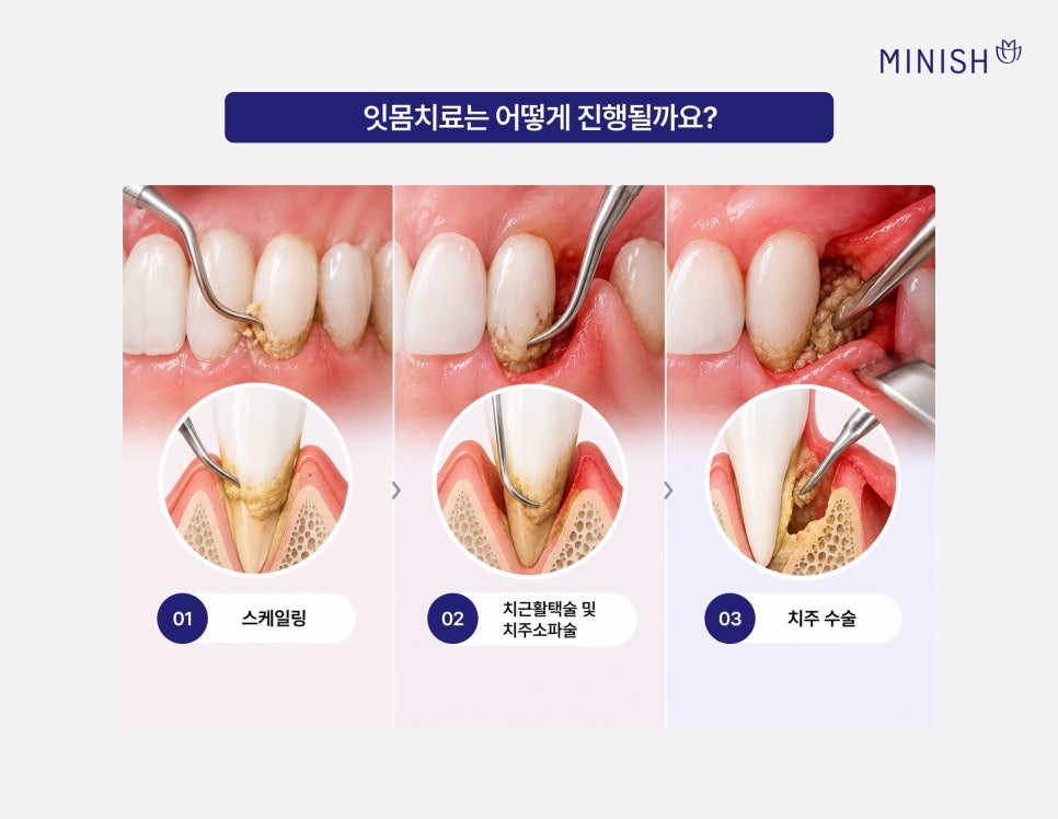 잇몸염증, 잇몸 부었을 때 필요한 치료는? 관련 이미지 5