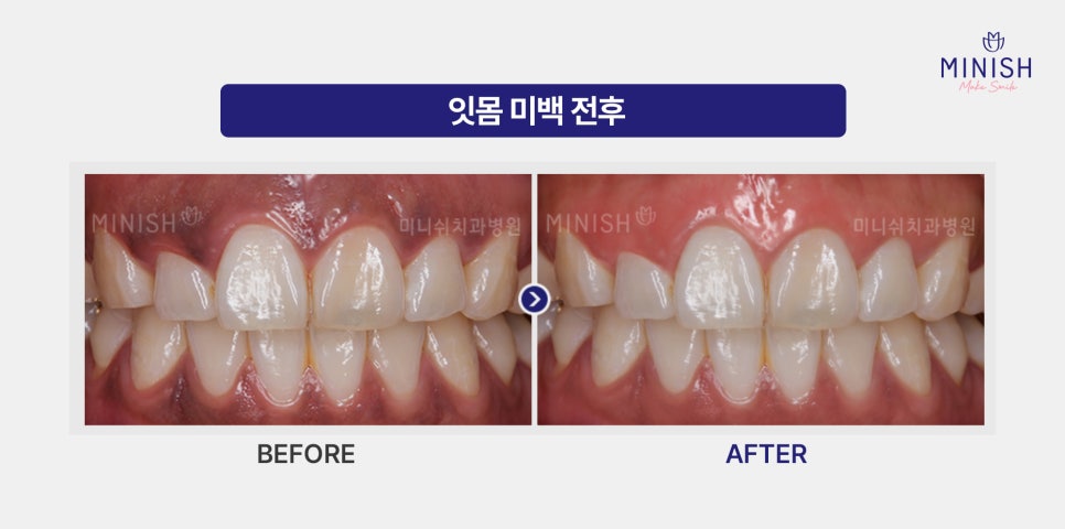 잇몸이 까매요 잇몸미백 필요한 경우 알아보기 관련 이미지 6