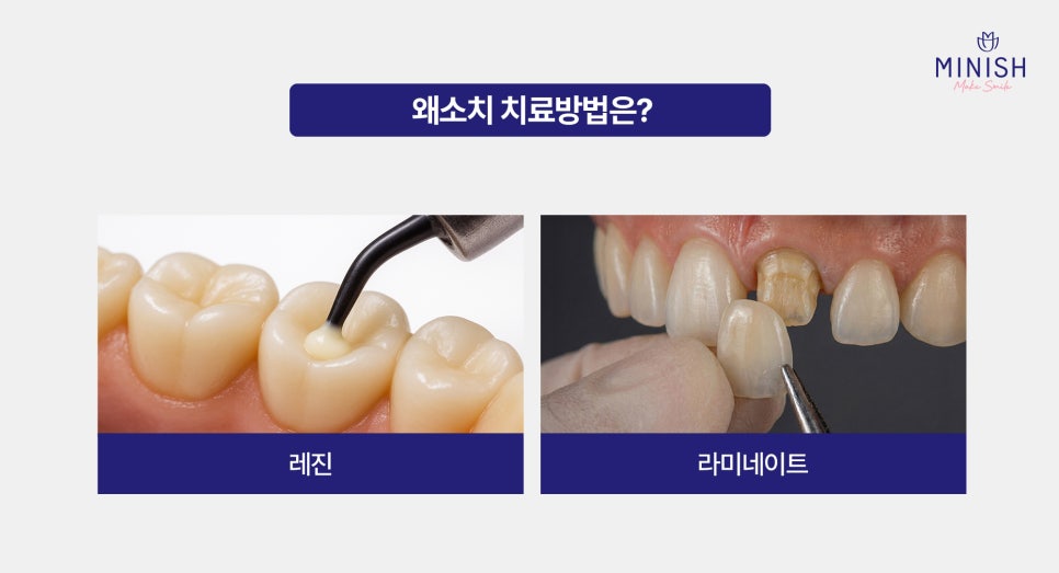 Problems That Occur If Small Teeth (Microdontia) Are Left Untreated! Treatment Methods Too! image 4