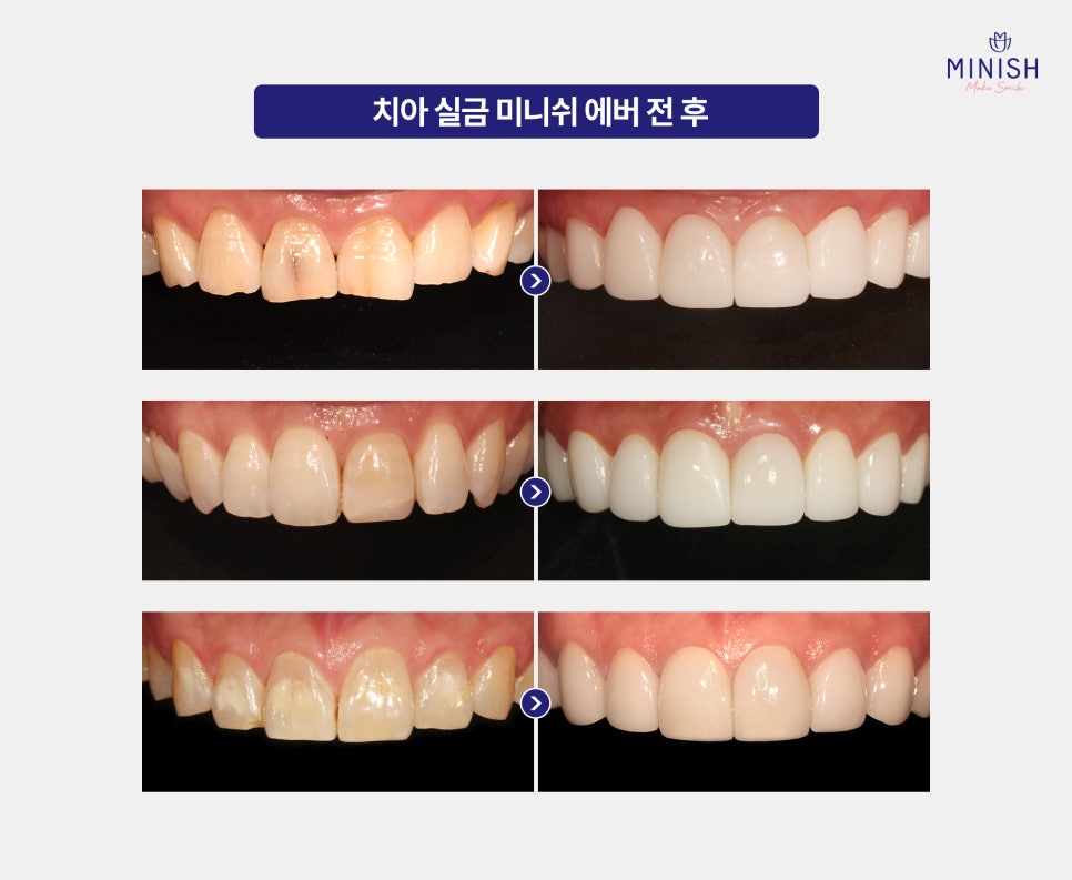 Have a Tooth Crack? You Shouldn’t Ignore It! From Causes to Improvement Methods image 5