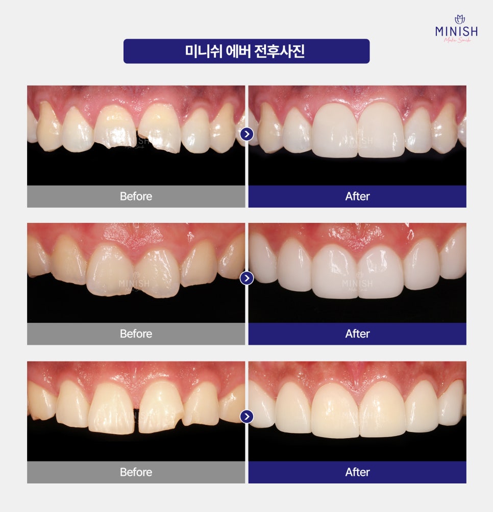 A chipped tooth: the fact that there is a way to restore it like a natural tooth! image 5