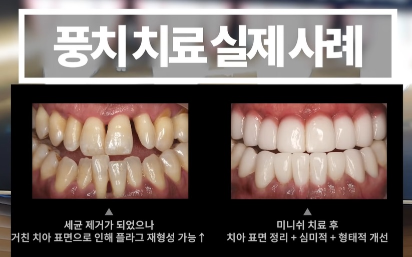 잇몸염증은 구강 적신호...가장 적극적인 잇몸치료는 미니쉬 관련 이미지 17