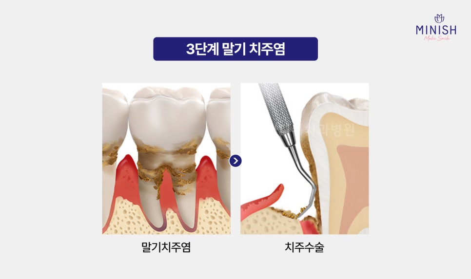 Bad Breath Causes: Could They Be More Serious Than You Think? A Summary of Solutions! image 10