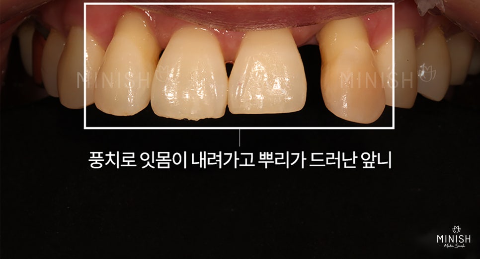 Are you wondering how to restore gums damaged by gum disease? image 5