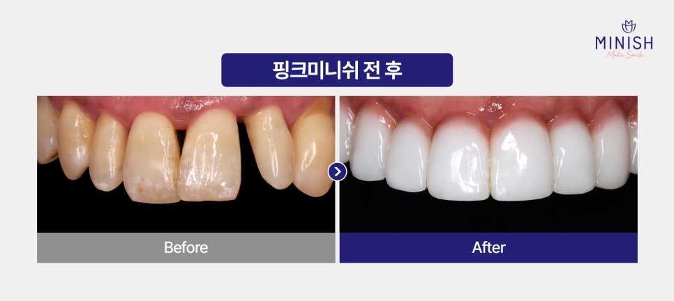 Bad Breath Causes: Could They Be More Serious Than You Think? A Summary of Solutions! image 8