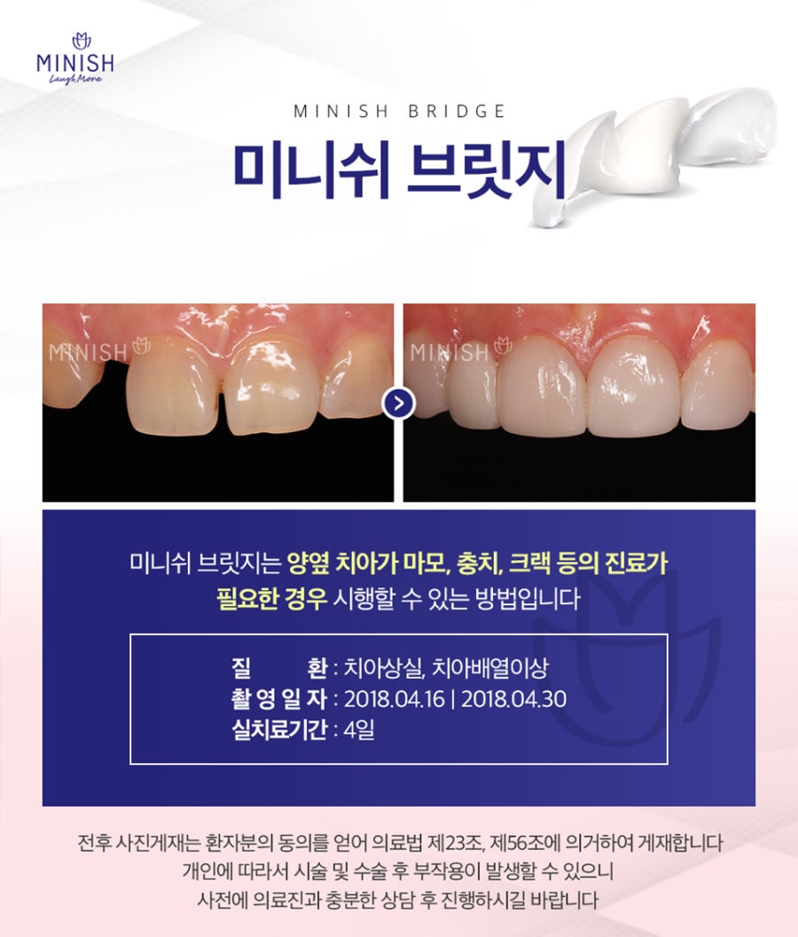 개인의 치아 구조에 맞춰 정교하게, 미니쉬 과정 | 청담동치과 관련 이미지 7
