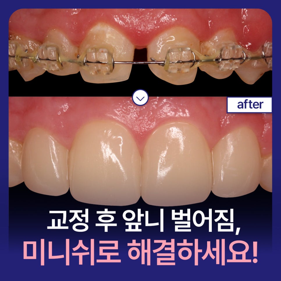교정 후 앞니 벌어짐, 미니쉬로 해결하세요! 관련 이미지 1