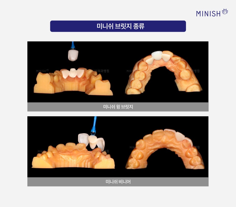 치아 브릿지, 자연치아를 보존하는 미니쉬 브릿지 관련 이미지 5