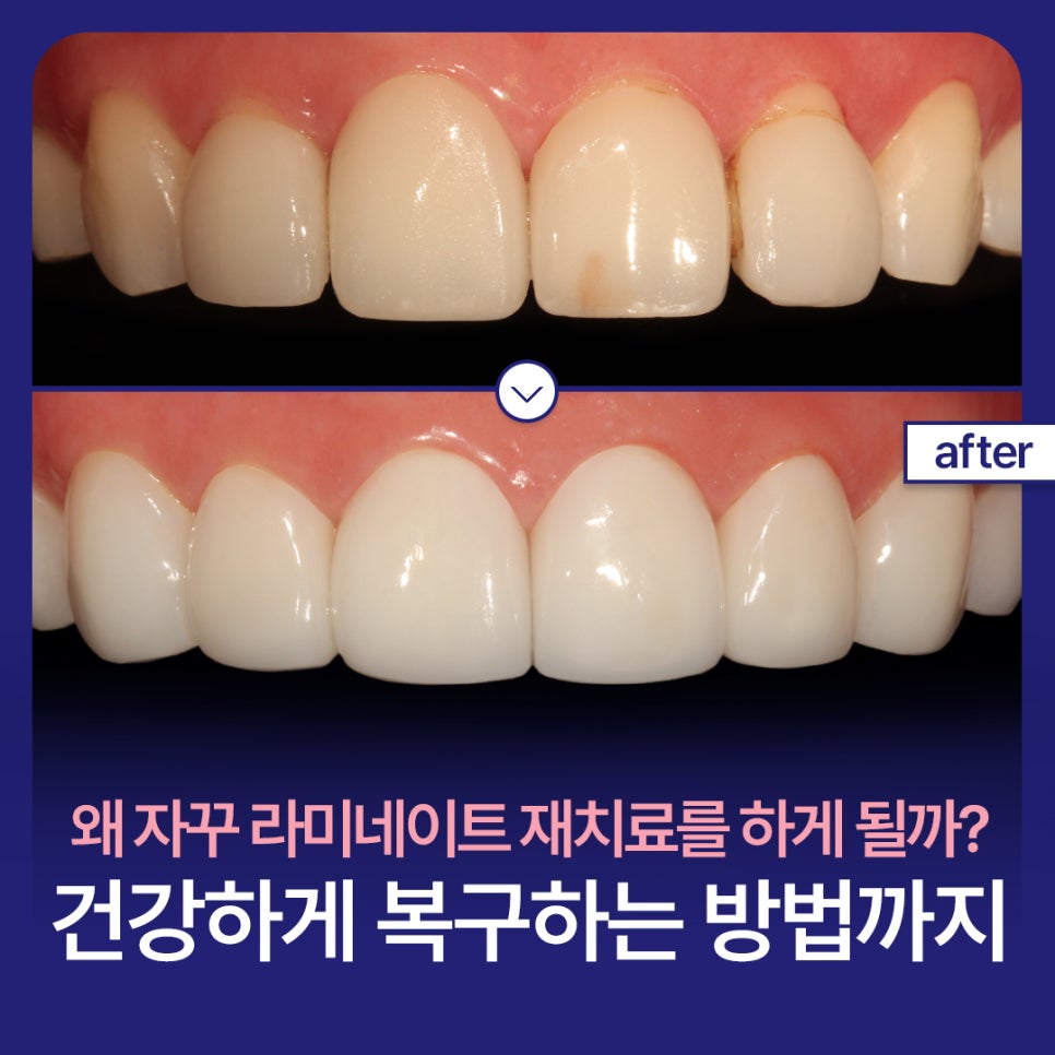 Why Do Veneers Keep Needing Retreatment? And How to Restore Them in a Healthy Way image 1