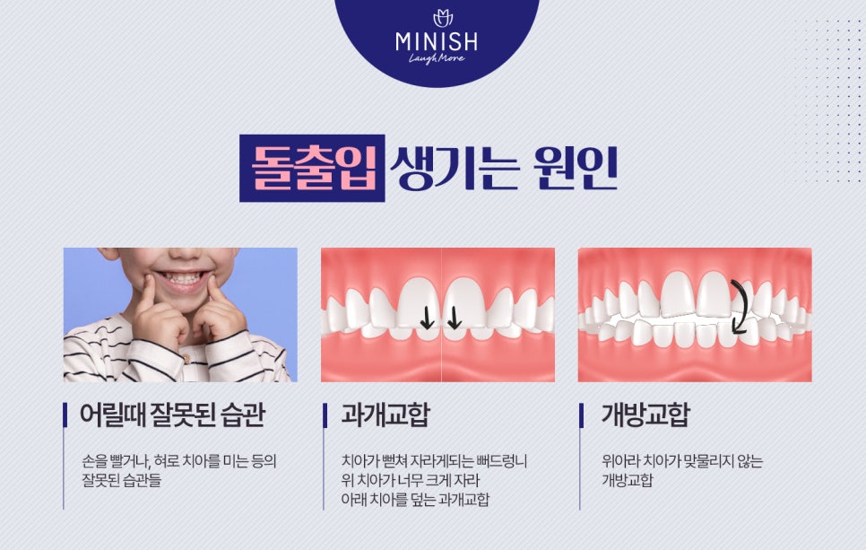 돌출입교정, 빠르게 치아의 비율까지 교정한다? 관련 이미지 3