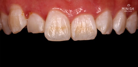 Is It Possible to Straighten Teeth in Just One Day? image 2