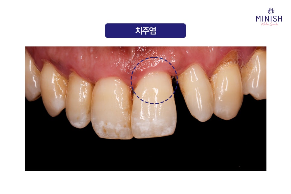 Swollen Gums and Bleeding? Warning Signs of Periodontal Disease image 5