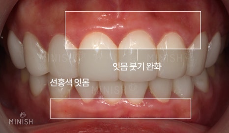 안성엄마와 딸을 괴롭힌 잇몸병 [엄마는예뻤다] 관련 이미지 16