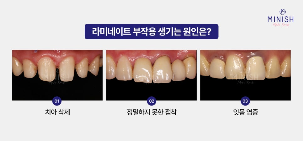 If You’re Considering Laminate Retreatment, Be Sure to Learn About the Side Effects and Healthy Restoration Methods! image 2