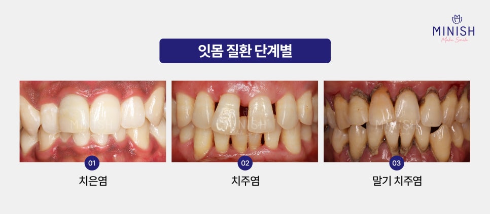 Gum Disease: Is It Just a Simple Problem? From Its Causes to Ways to Restore It image 4