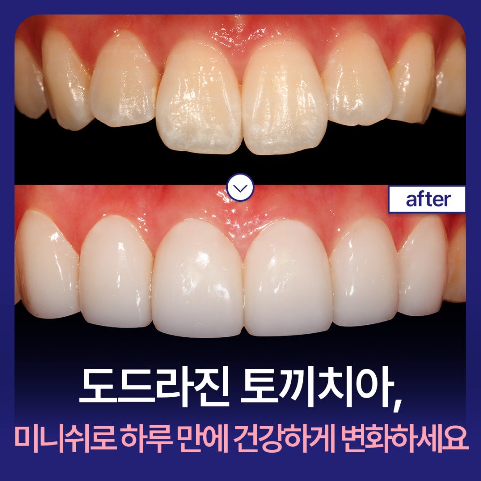 Prominent Rabbit Teeth: Change to a Healthier Smile in Just One Day with Minish image 1