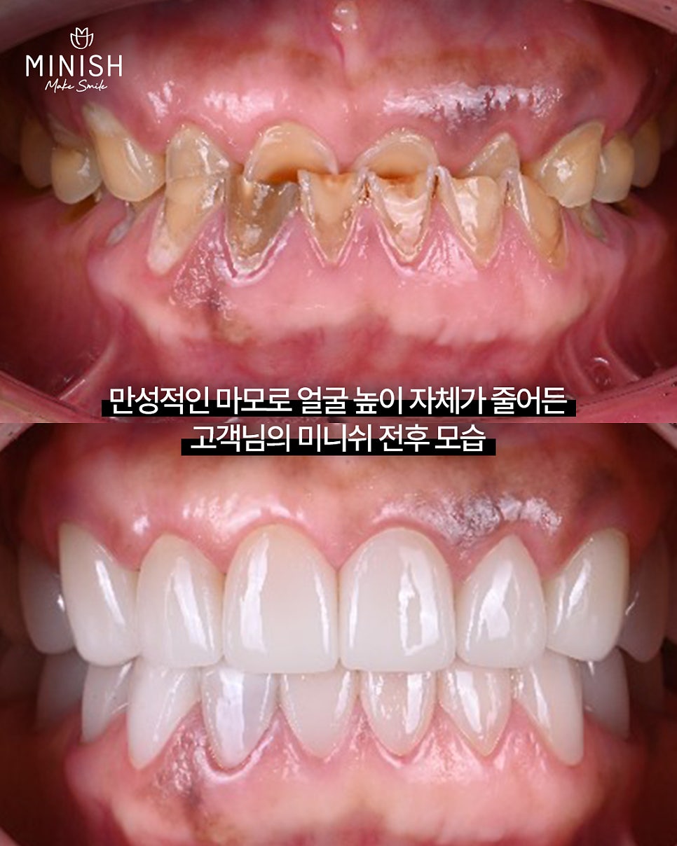 If Your Teeth Have Worn Down and Even Changed Your Face, Can They Be Restored? A Case Repaired with Minishe image 5