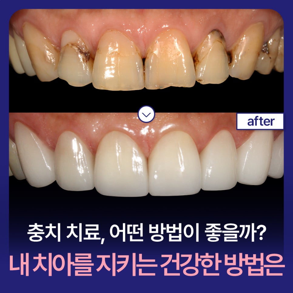 What Is the Best Way to Treat Cavities? What Is a Healthy Way to Protect My Teeth? image 1