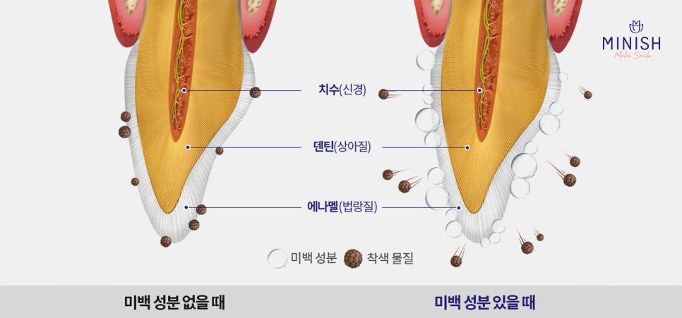 누런 치아? 치아변색 원인과 치료방법은? 관련 이미지 4