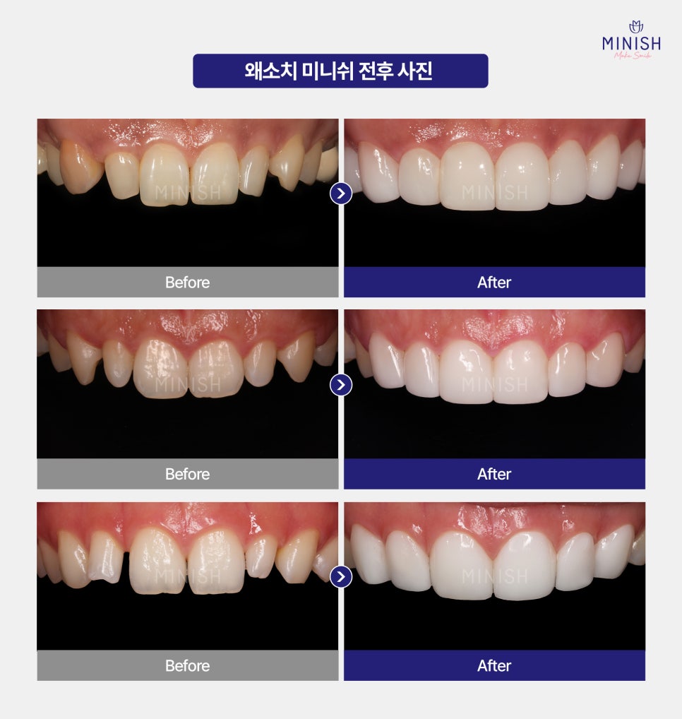 Problems That Occur If Small Teeth (Microdontia) Are Left Untreated! Treatment Methods Too! image 6