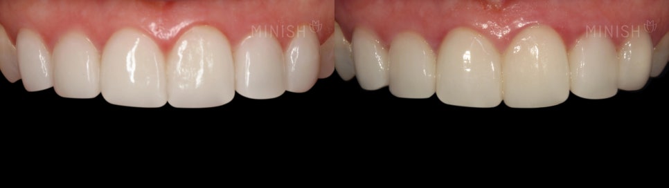 The Difference Created by Technology: A Complete Comparison of Minish vs. Laminate image 13