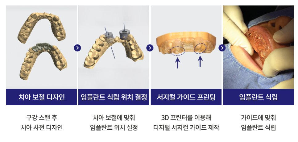 충치 근본 원인을 해결하는 미니쉬를 활용한 충치치료 관련 이미지 5
