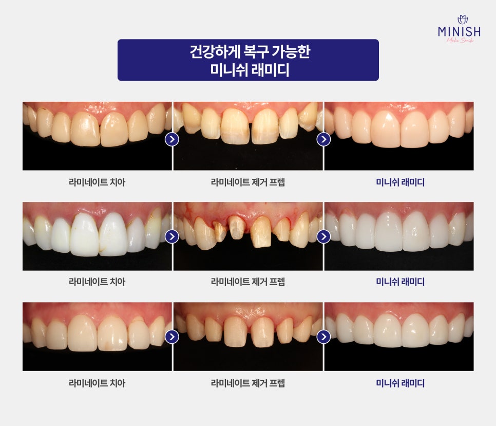 Why Do Veneers Keep Needing Retreatment? And How to Restore Them in a Healthy Way image 5