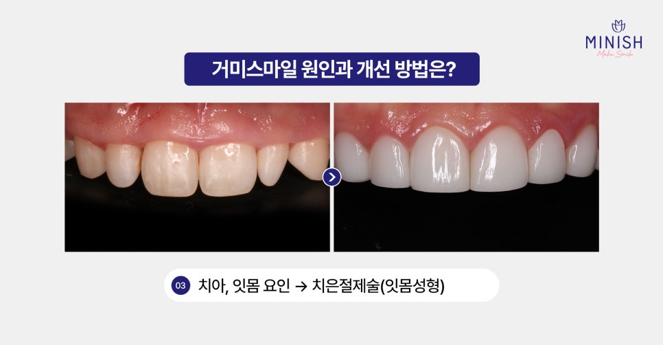Gummy Smile: Why the Gums Show So Much When You Smile and How to Improve It image 4
