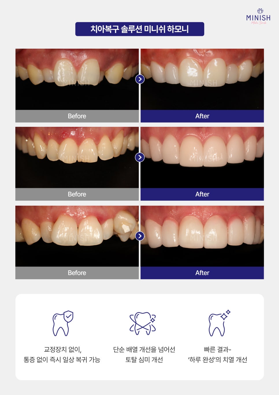 Worried About Orthodontics? Improve in One Day with Minish Harmony! image 4
