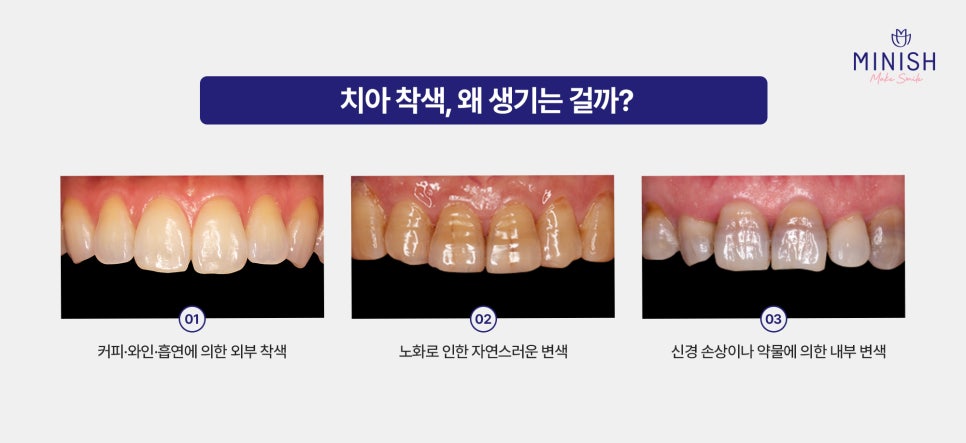 누런 치아 착색 원인부터 해결법까지, 치아미백치과 선택 전 필독! 관련 이미지 2