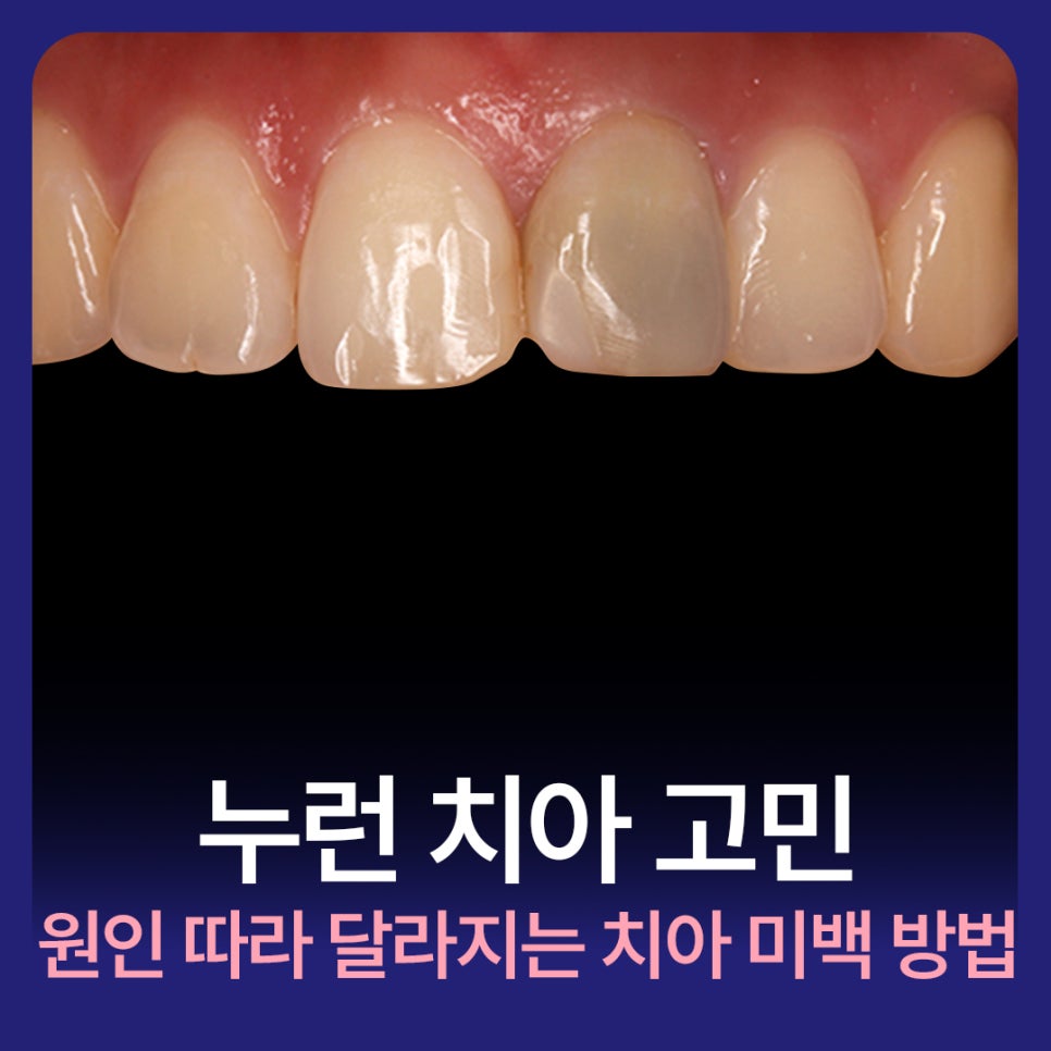 Yellow Teeth Concerns: Teeth Whitening Methods That Vary by Cause image 1