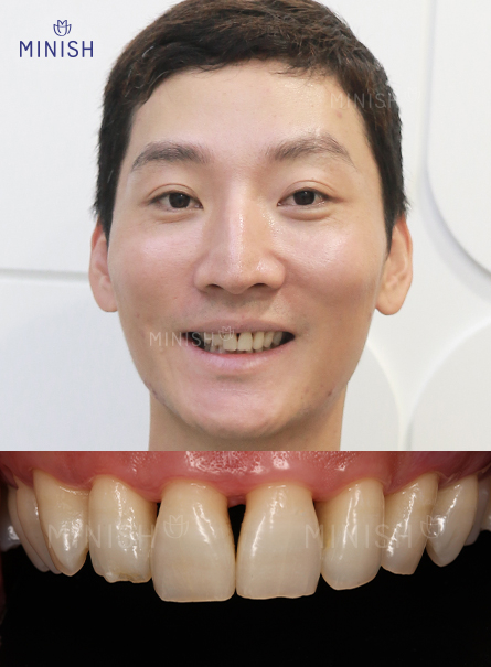 통증 부르는 부은 잇몸 멈춰! 건강한 미니쉬로 해결하세요 관련 이미지 2