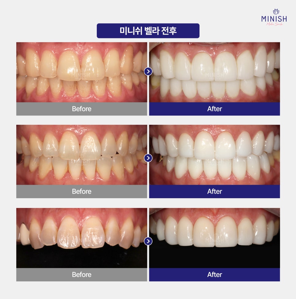 Yellow Teeth, From Causes to Solutions! Which Method Is Right for Me? image 8