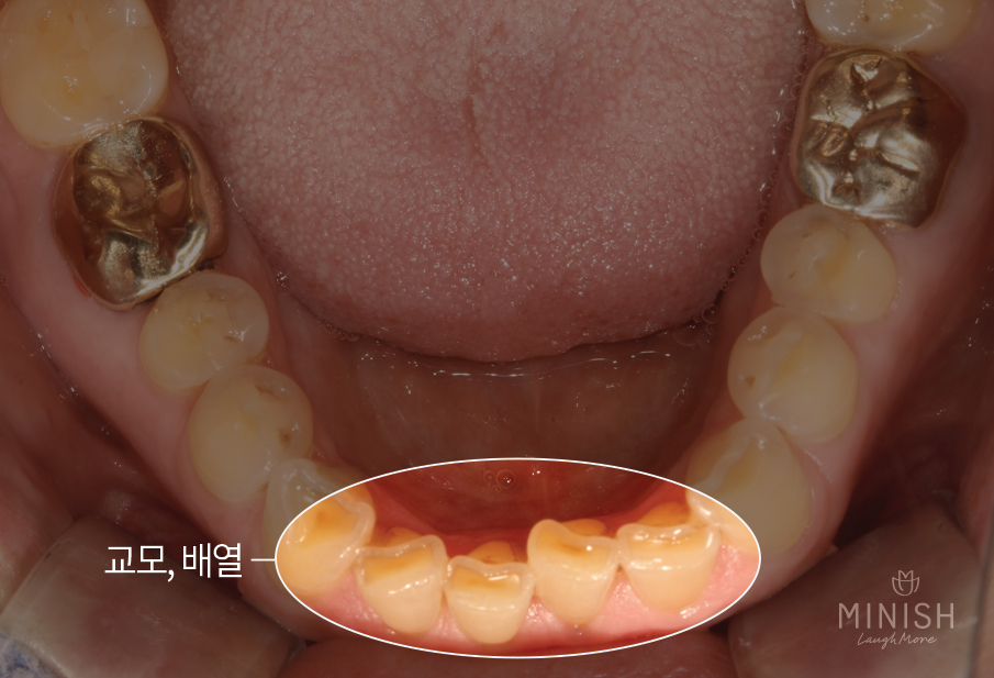천안엄마의 치아노화, 미니쉬로 치아코팅하다 [엄마는예뻤다] 관련 이미지 11