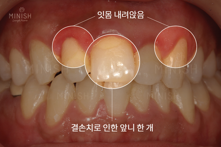 가평엄마 아들의 결손치, 미니쉬로 복원! [엄마는 예뻤다] 관련 이미지 11
