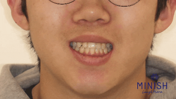 가평엄마 아들의 결손치, 미니쉬로 복원! [엄마는 예뻤다] 관련 이미지 14