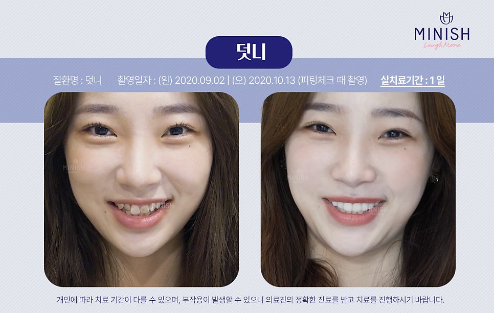 부정교합종류, 하루만에 교정할 수 있는 방법도 있을까? 관련 이미지 7