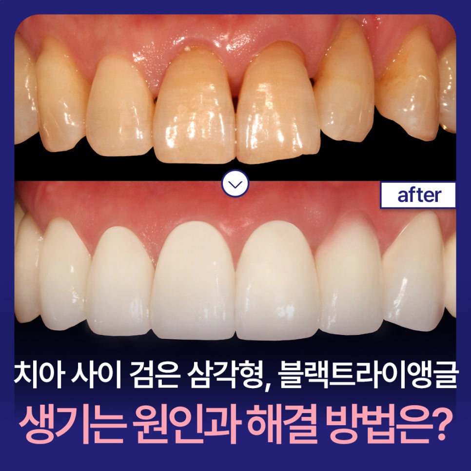 Black Triangles Between Teeth: What Causes Black Triangles and How Can They Be Resolved? image 1