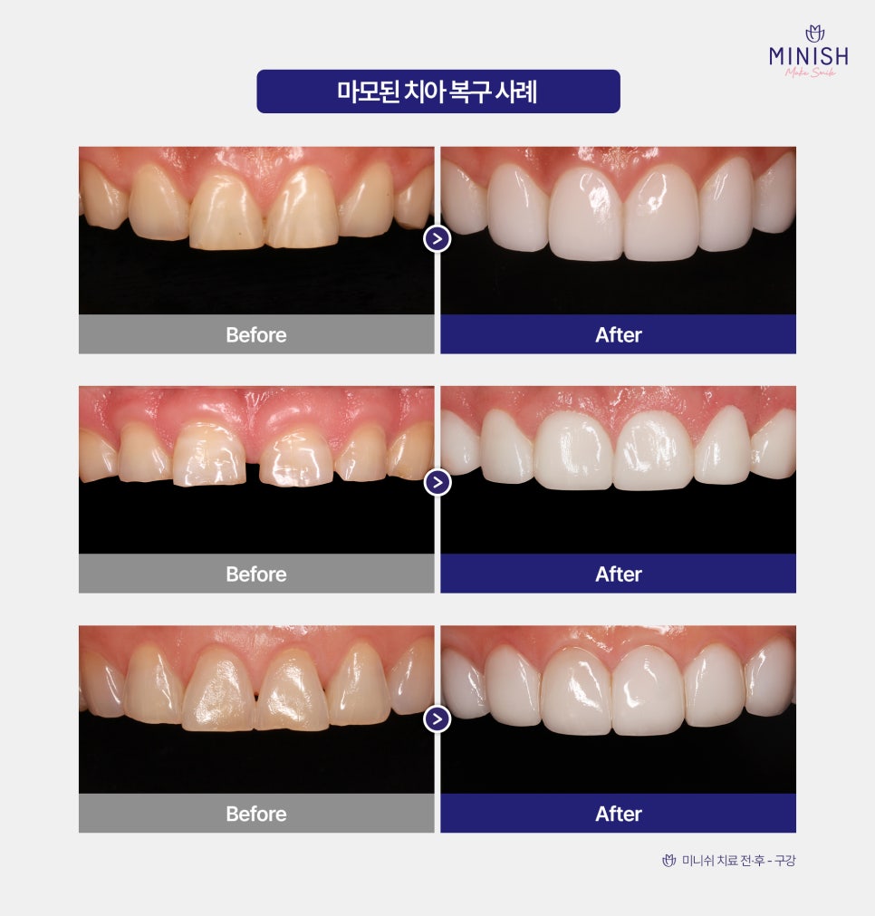 Regret It If You Leave Tooth Wear Untreated! What Are the Ways to Restore It Healthily? image 6